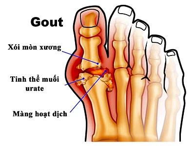 Tìm hiểu về bệnh Gút