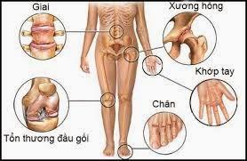 Triệu chứng bệnh thấp khớp và hướng điều trị